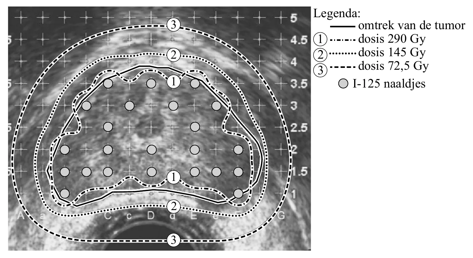 Legenda: 3 omtrek van de tumor 1 dosis 290 Gy 2 2 dosis 145 Gy dosis 72,5 Gy 3 1 I-125 naaldjes 1 2 3